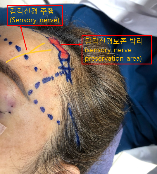 Forehead Reduction Surgery to Naturally Lower the Hairline image 2