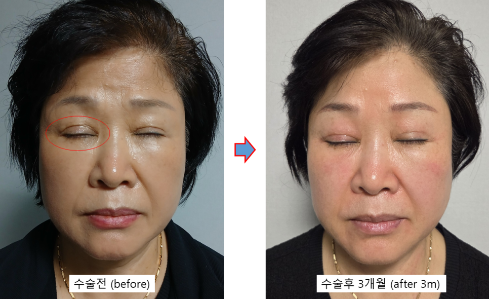 상안검 수술 후에도 눈이 불편하다면? &ndash; 눈 재수술과 이마거상을 함께 하는 이유 관련 이미지 5