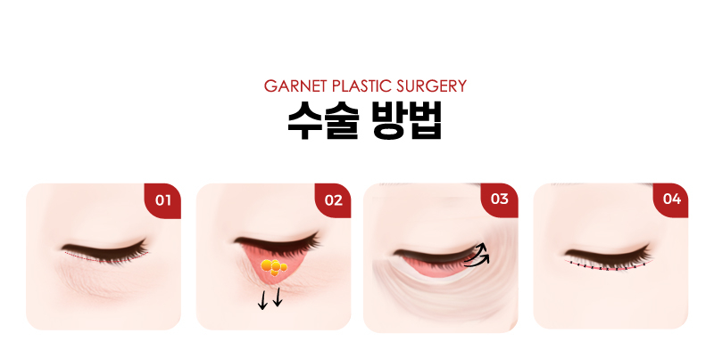 【Garnet Plastic Surgery Director Insoo Baek’s Plastic Surgery Column】 Lower Blepharoplasty Case in a Woman in Her Late 50s image 4