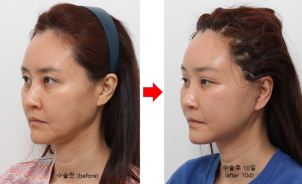사각턱 수술 후 처진 턱라인을 개선하는 딥 미니거상 관련 이미지 3