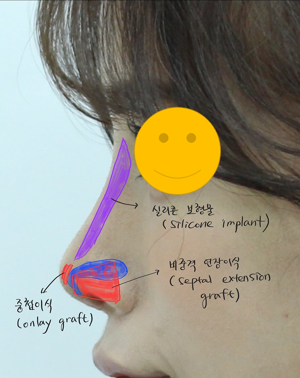 코필러 퍼짐과 필러비침현상(틴들현상) 관련 이미지 8