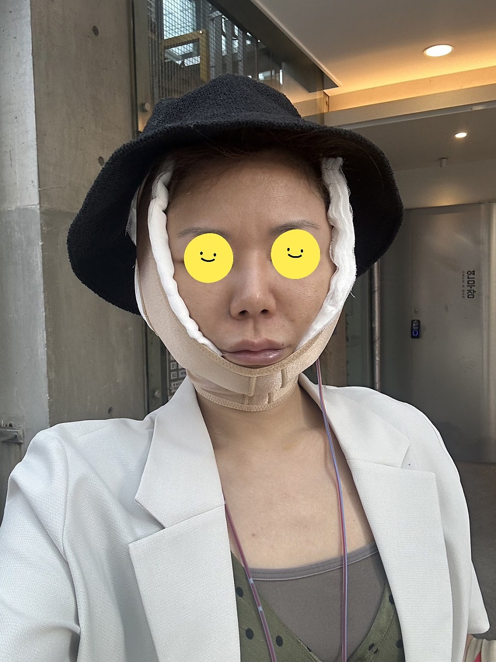 Swelling the Day After a Facelift image 4