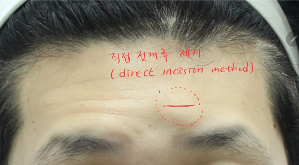 내시경 이마거상과 함께 시행한 골종제거 관련 이미지 4