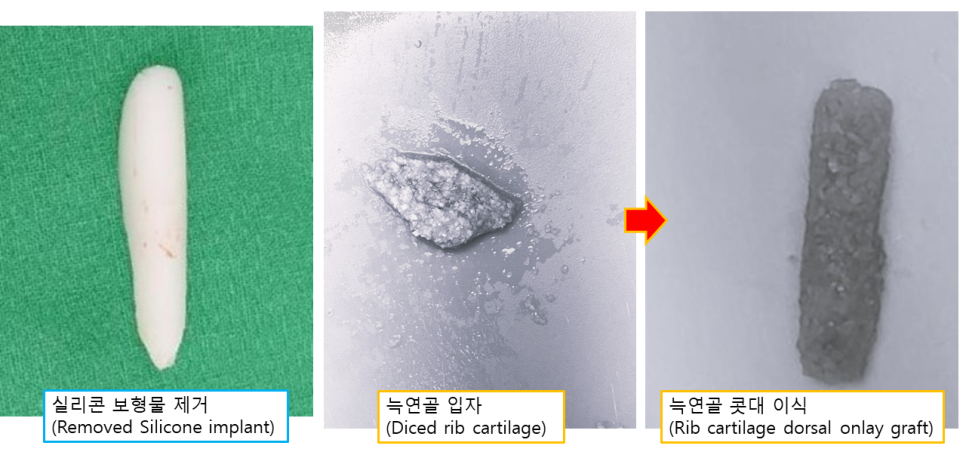 늑연골로 만든 콧대, 정말 흡수될까요? 관련 이미지 2
