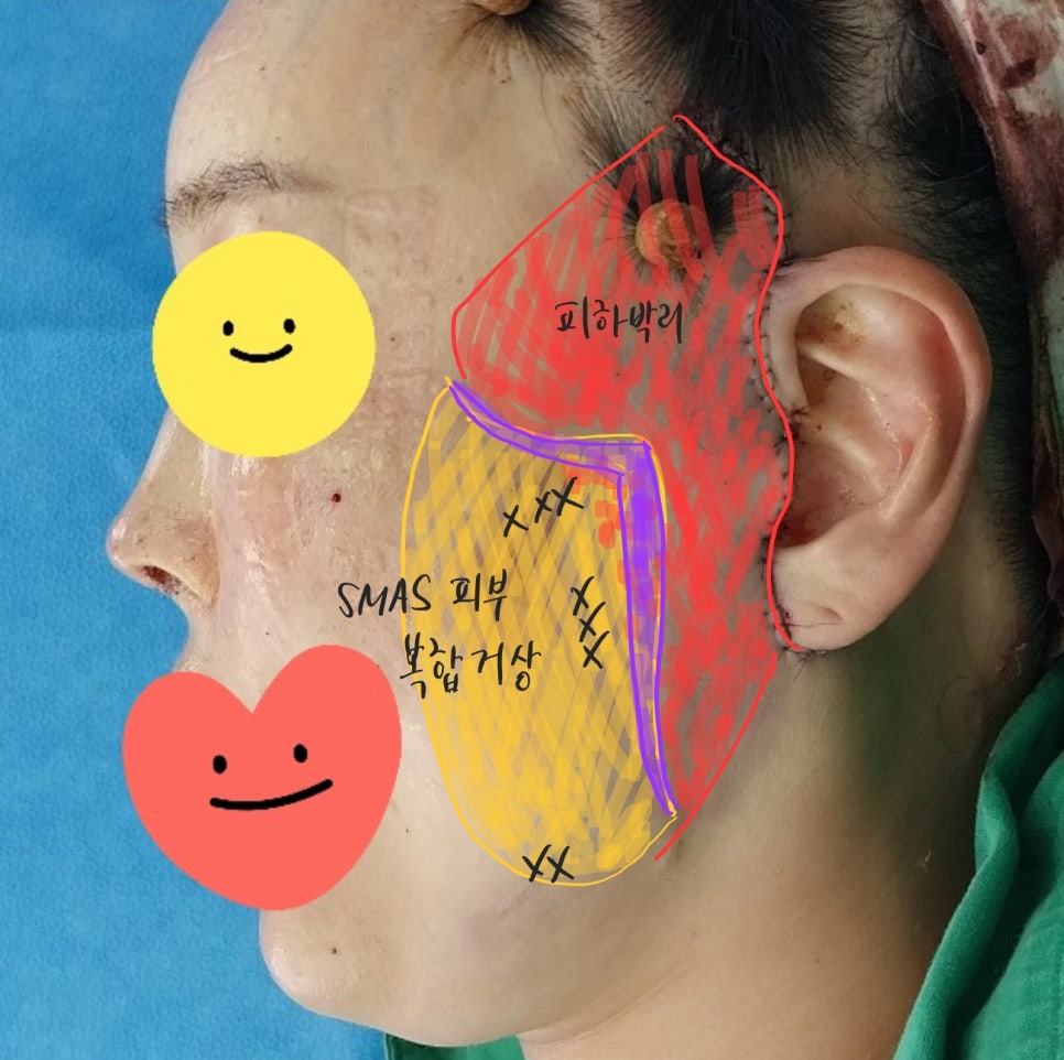 Changes in Incisions and Scars in Deep Mini Facelift image 1