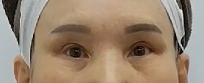 애교살을 보존하는 하안검 수술 관련 이미지 2