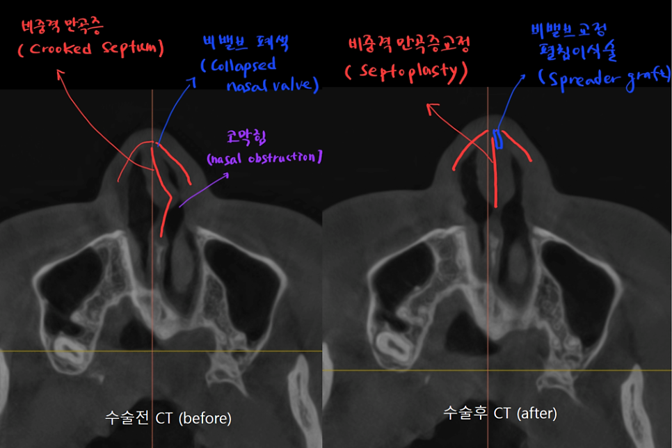 Rib Cartilage Rhinoplasty for a Deviated Saddle Nose image 15