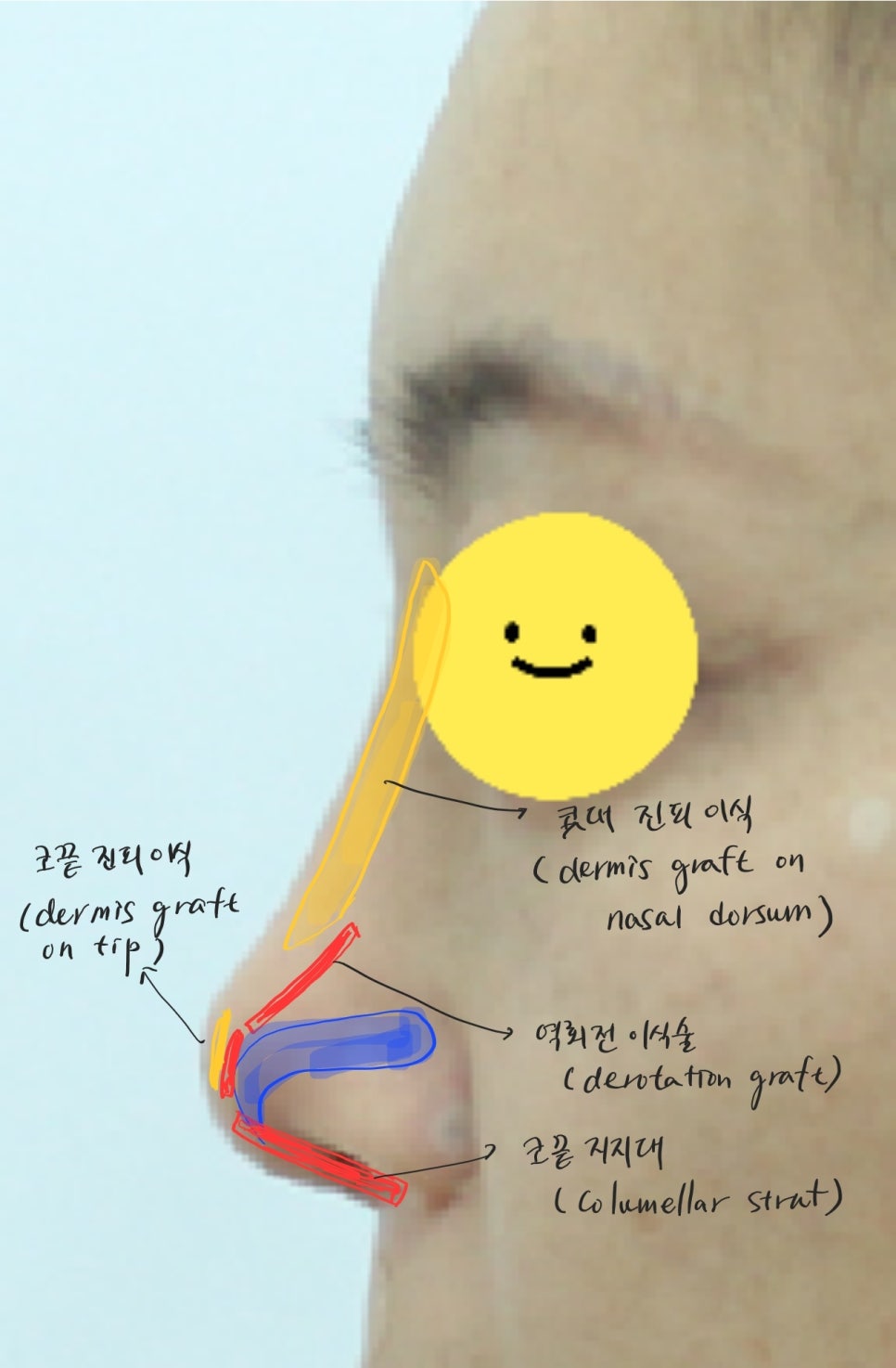 실과 필러로 높힌 코에서 발생한 염증의 치료 관련 이미지 9