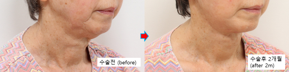 심한 목처짐 개선, 목거상의 핵심은 심부 볼륨과 피부 재배치입니다 관련 이미지 6
