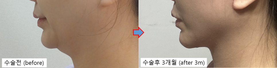 The Evolution of Double-Chin Surgery: From Liposuction to Pelican Surgery image 5