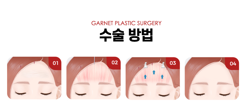압구정역성형외과에서 알아보는 대표적인 동안성형 종류! 관련 이미지 10