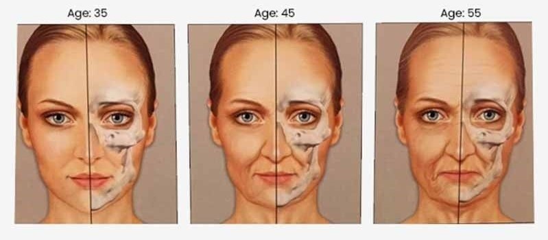Does a Smaller Facial Skeleton Sag Faster? A Deep Mini Facelift Case in a Patient in Her 40s image 2