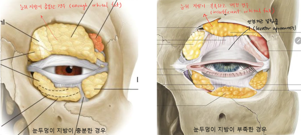 꺼진눈 쌍꺼풀 수술에서 필요한 눈위지방재배치 관련 이미지 1