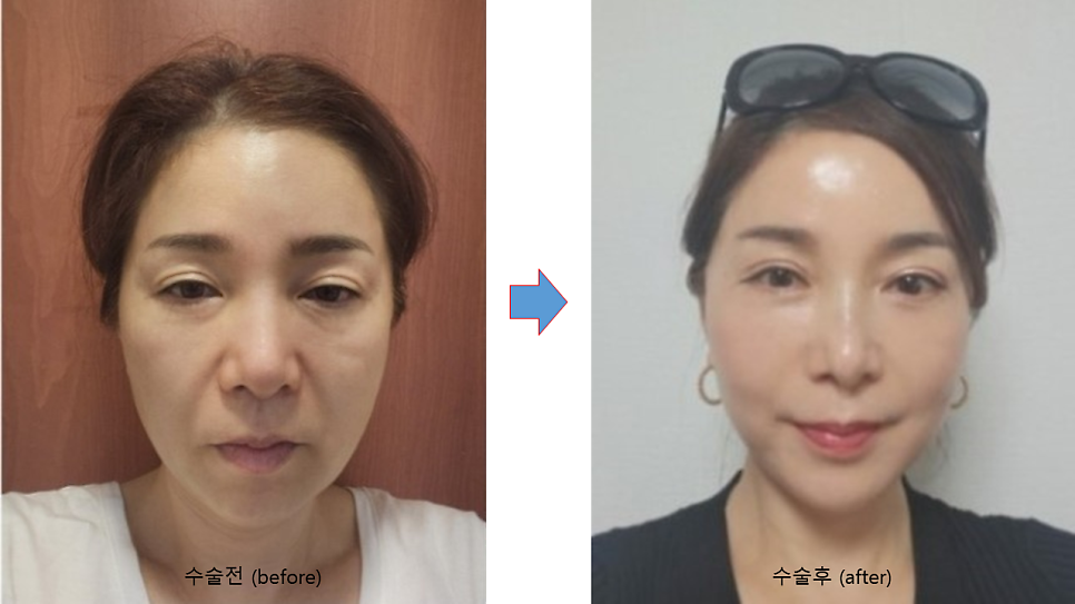 안면거상후 흉터 성숙과정 관련 이미지 5
