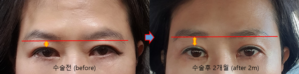 Jang Young-ran’s Brow Lift: Why It Made Her Look Younger, But Isn’t the Right Answer for Everyone image 6