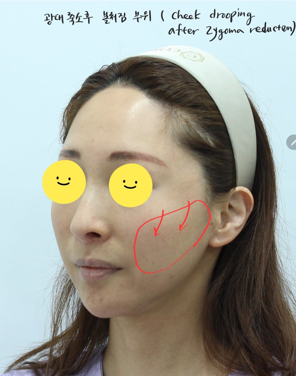 안면윤곽 수술 후 피부처짐의 치료 관련 이미지 3