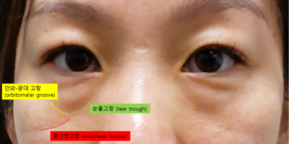 눈밑지방재배치, 눈밑에서 중안면까지 자연스럽게 관련 이미지 1