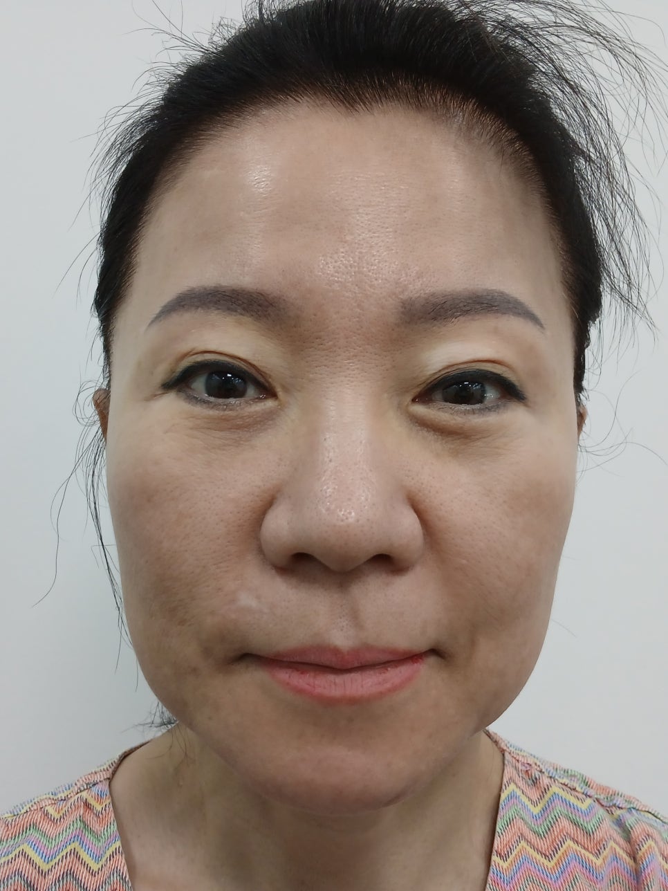 After a Face Lift, When Will Swelling and Bruising Go Away? Recovery Process and Natural Results image 1