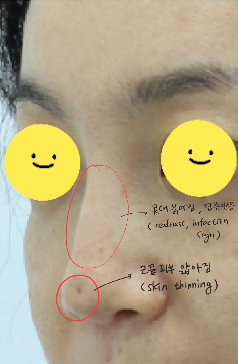 실과 필러로 높힌 코에서 발생한 염증의 치료 관련 이미지 3