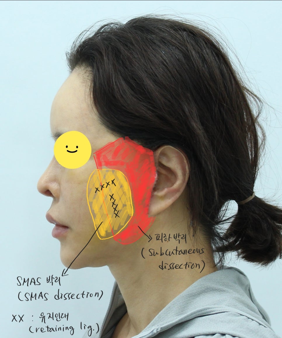 딥 미니거상을 통한 이주의 재건 관련 이미지 3