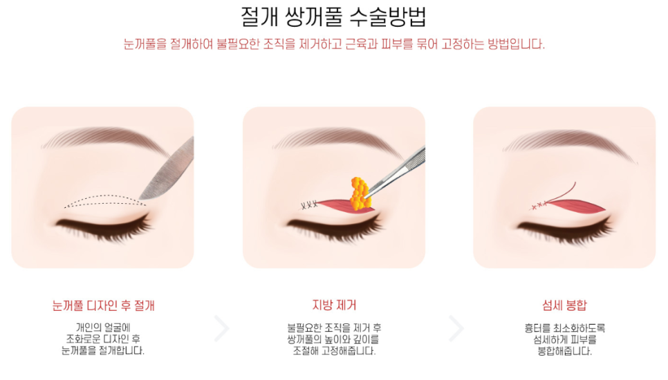 First-Eye Surgery with a Non-Incision Method (Buried Suture Double-Eyelid Surgery) image 1