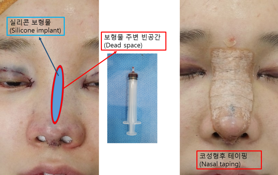 Will Rhinoplasty Cause Inflammation If You Have It in the Summer? Here’s a Real Recovery Case image 3
