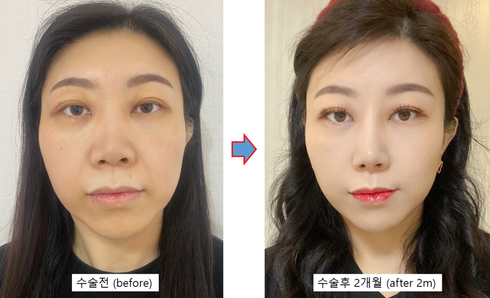 Rhinoplasty + Forehead Fat Grafting: Why the Face’s Mood Changes image 2