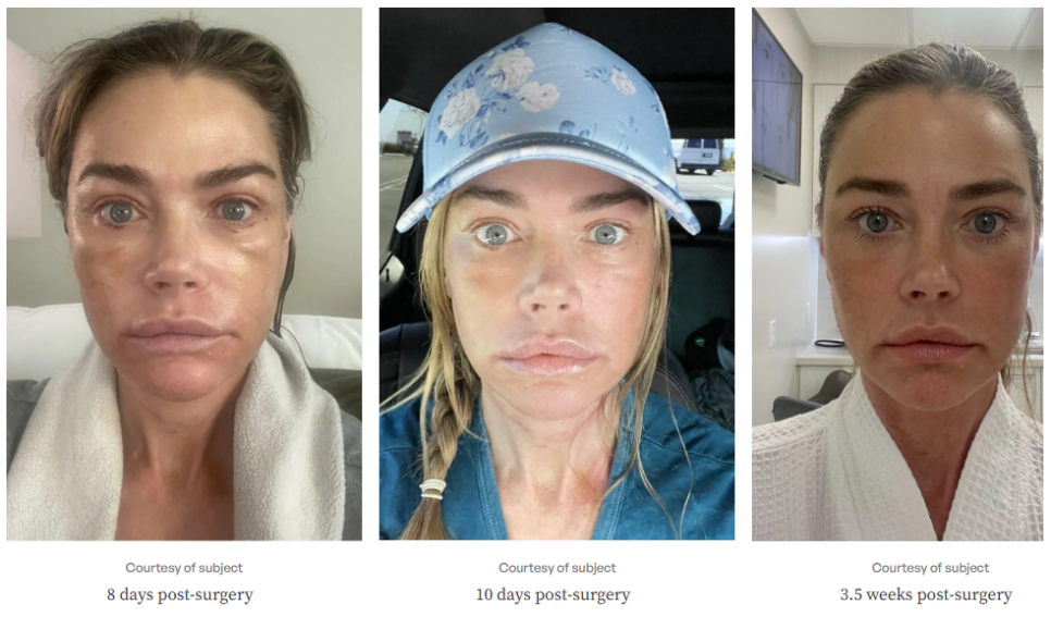 The Result of the $200,000 Anti-Aging Surgery Chosen by a Hollywood Star image 6