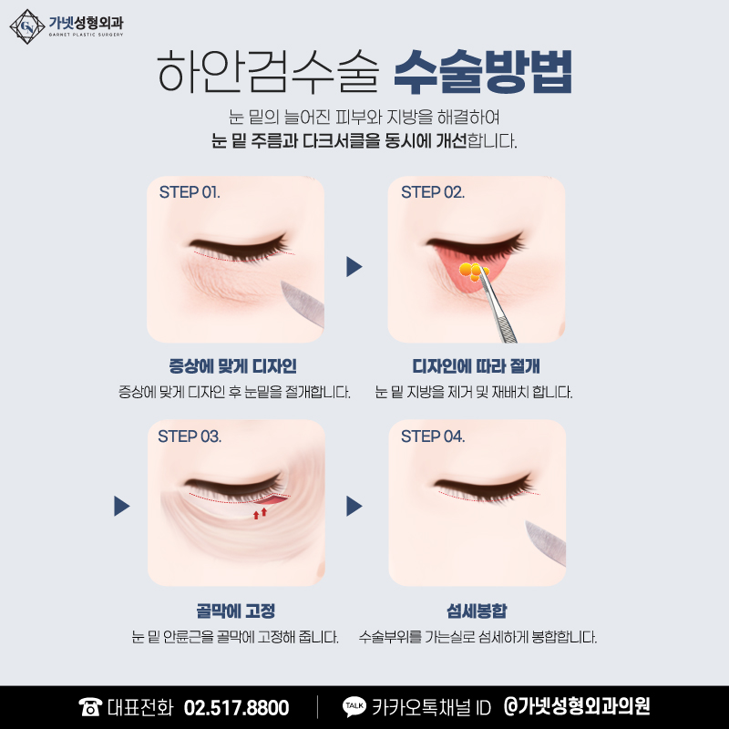 눈밑하안검수술 10년은 어려보이는 동안눈성형 관련 이미지 3