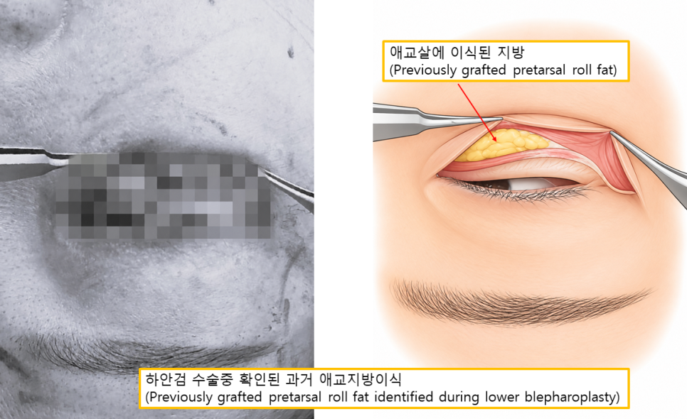 애교지방이식과 애교필러, 자연스러움과 유지기간의 차이 관련 이미지 5