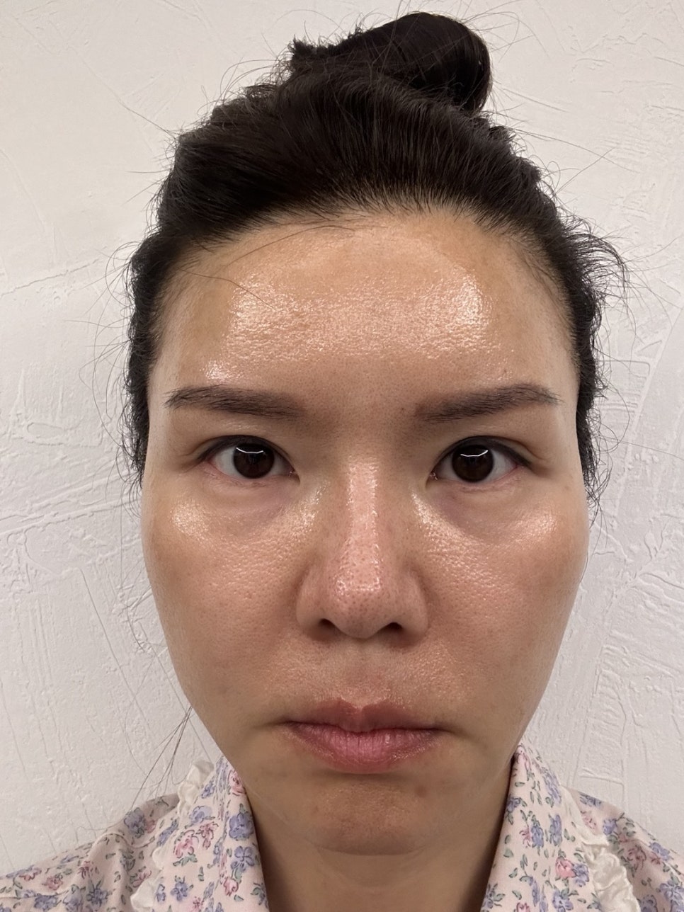 40대 후반 눈밑성형, 꼭 하안검일까? 눈밑지방재배치로 해결한 이유 관련 이미지 1