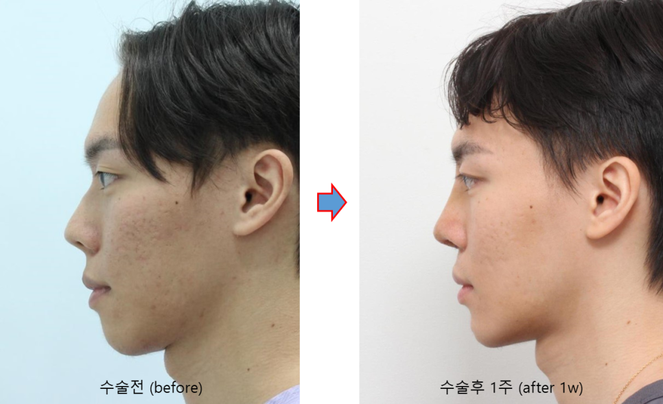 코뼈를 깎지 않는 코성형? 3D CT 맞춤형 코보형물 관련 이미지 5