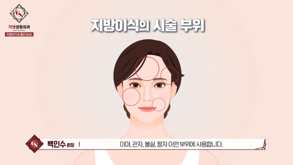 동안 볼륨성형 지방이식과 필러의 차이! 지방이식이 필요한 유형은? 관련 이미지 5