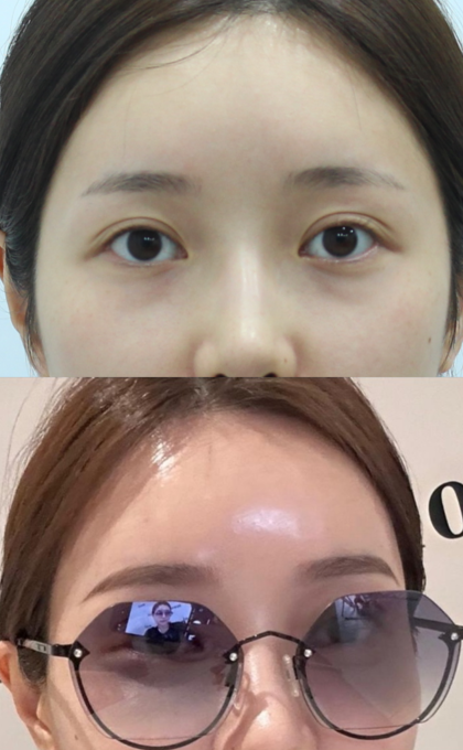 피부장벽을 통과하는 적절한 스킨부스터 시술 관련 이미지 8