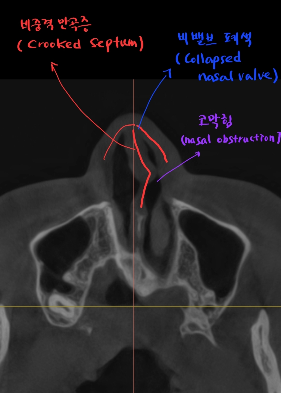 Rib Cartilage Rhinoplasty for a Deviated Saddle Nose image 2