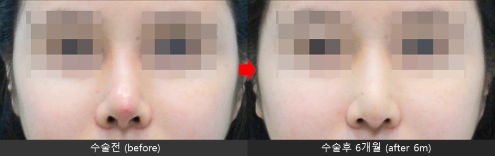 Nasal Tip Skin Irritation Caused by L-Shaped Silicone image 7