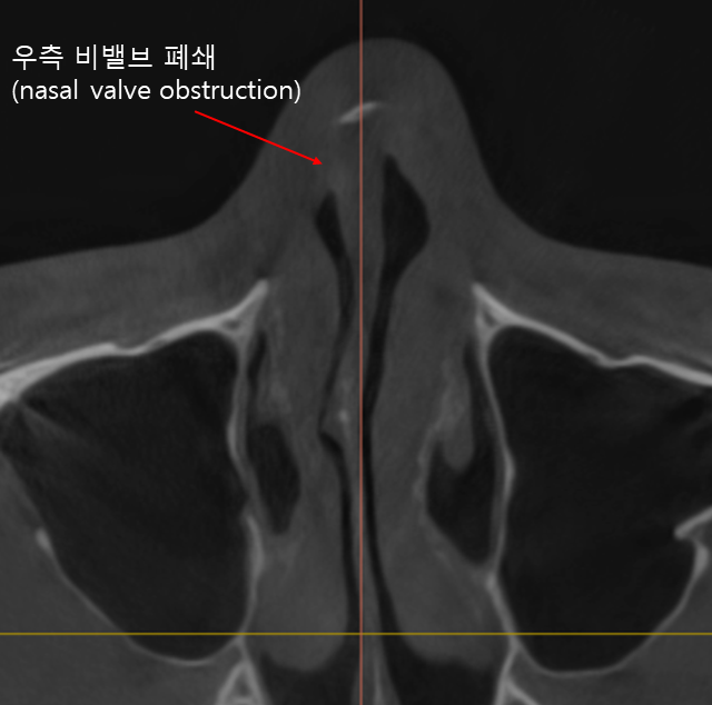 Male Rhinoplasty Performed Alongside Septoplasty image 1