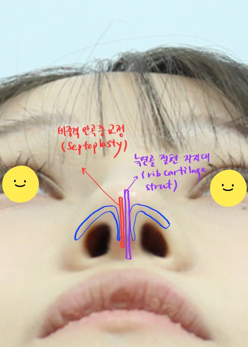 Rib Cartilage Rhinoplasty for a Deviated Saddle Nose image 6