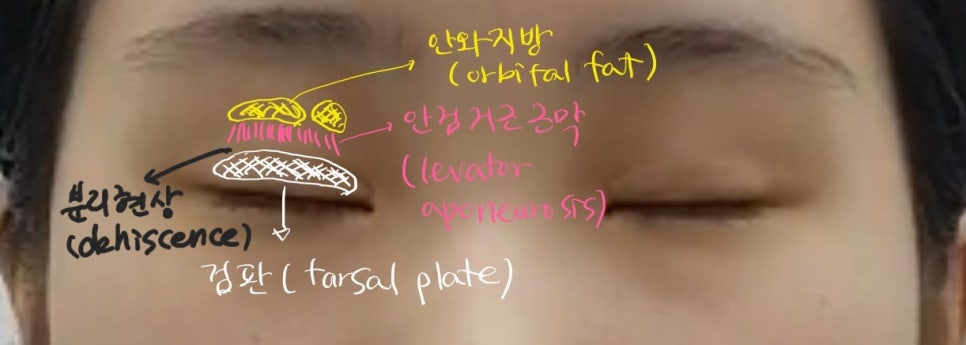 안검하수가 동반된 짝눈의 쌍꺼풀 재수술 관련 이미지 5