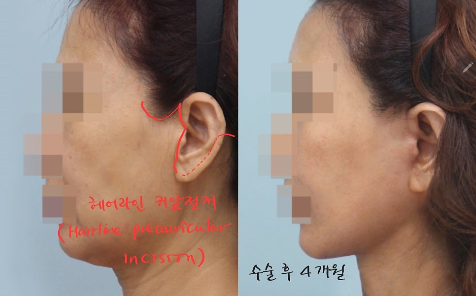 안면거상에서 절개선의 선택방법 관련 이미지 8