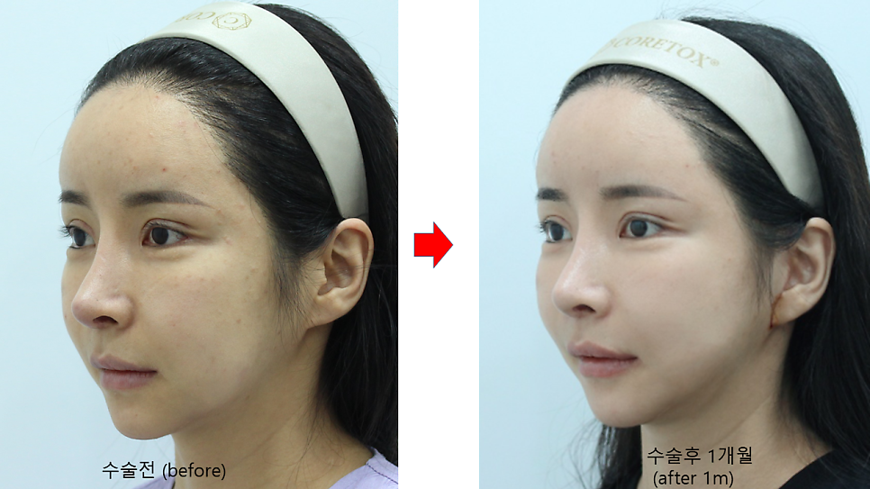 Sagging Skin After Facial Contouring Surgery (Cheek Sagging) image 9