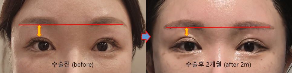 Jang Young-ran’s Brow Lift: Why It Made Her Look Younger, But Isn’t the Right Answer for Everyone image 4