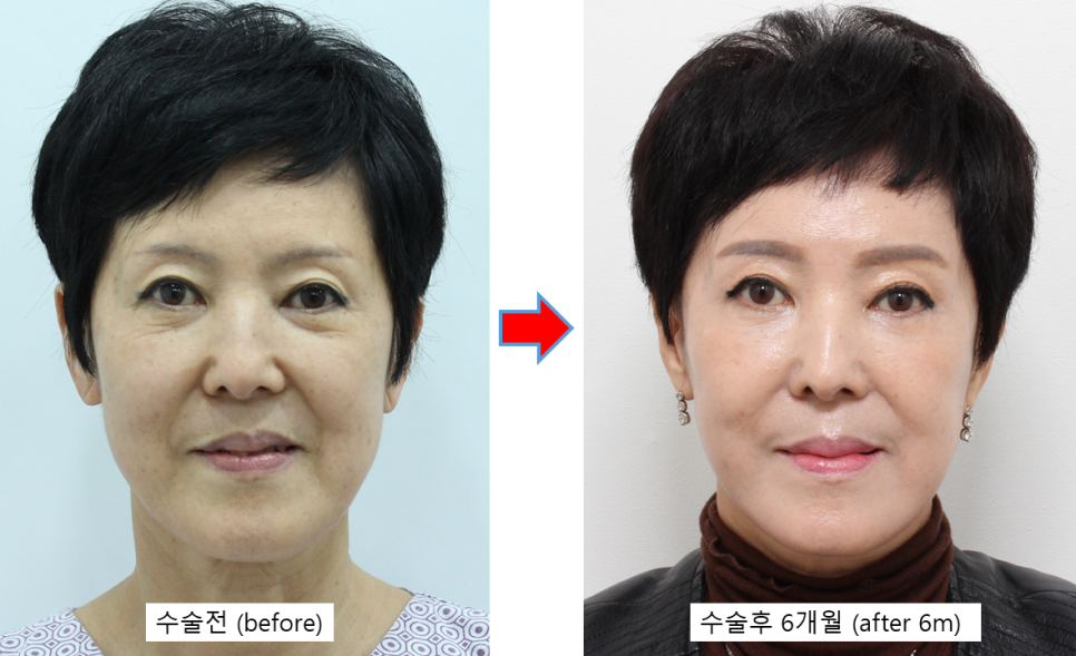 자연스러운 안면거상의 최종결과 관련 이미지 1