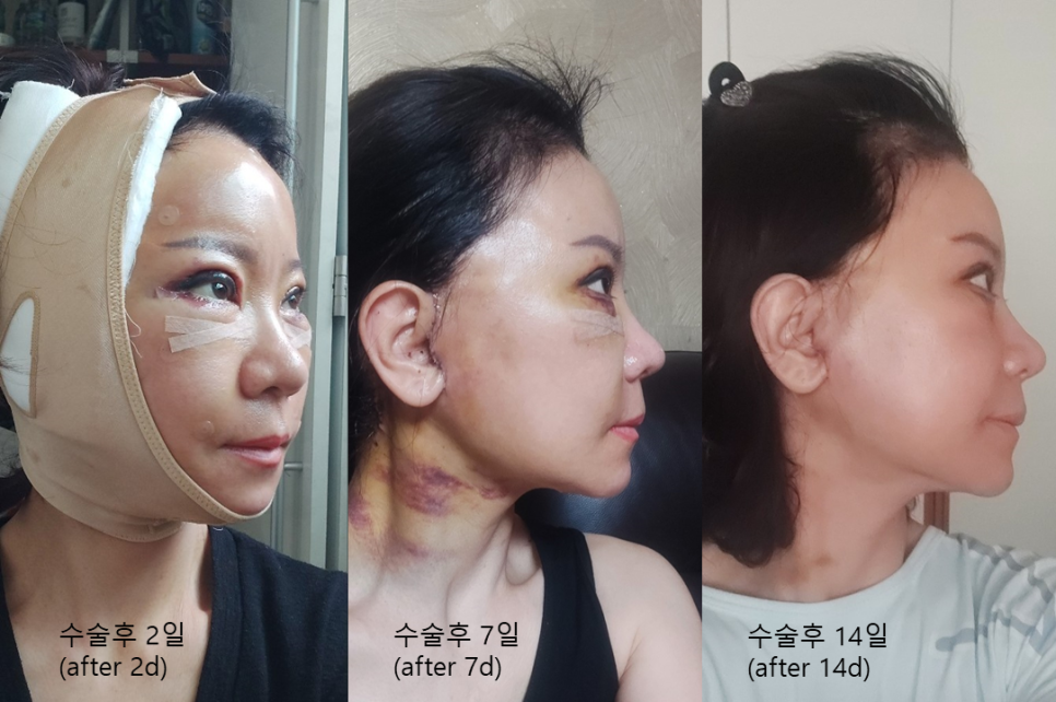 After a Face Lift, When Will Swelling and Bruising Go Away? Recovery Process and Natural Results image 3