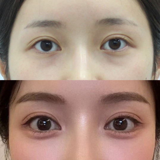 눈 아래부분을 화려하게 만드는 눈성형 관련 이미지 8