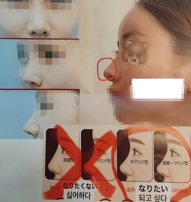 Consultation Process and Surgical Items for Revision Rhinoplasty image 4