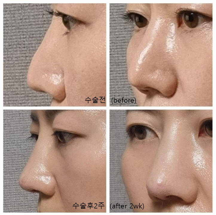 고어텍스 보형물을 자가조직으로 교체하는 코성형 관련 이미지 6