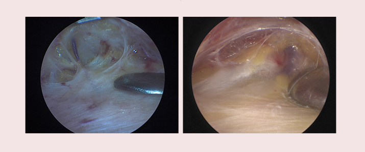 【Garnet Plastic Surgery Dr. Baek Insoo’s Plastic Surgery Column】 Fast Recovery After Pentafix Forehead Lift image 4
