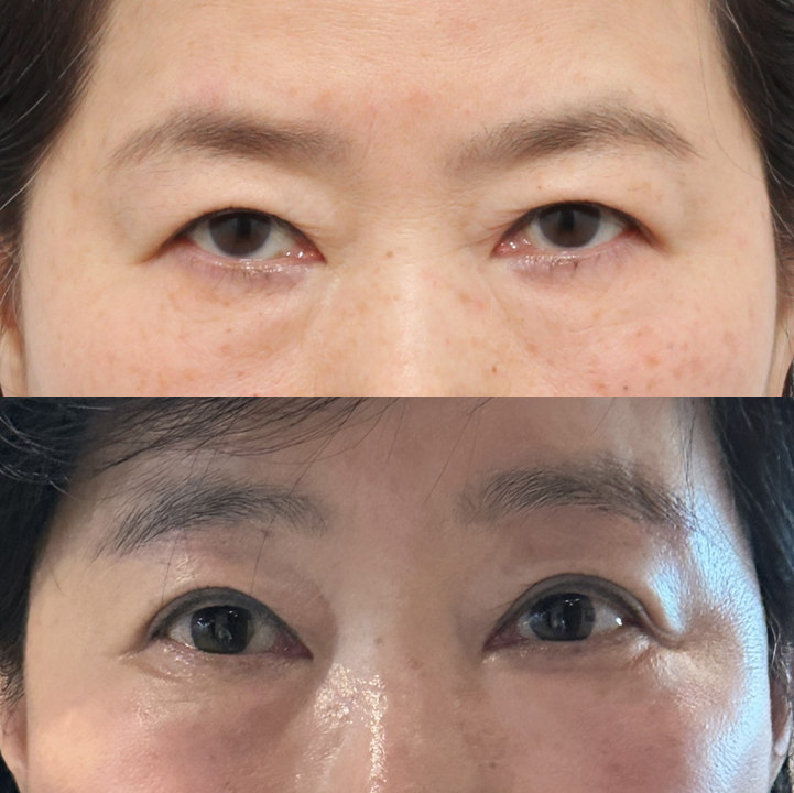 눈썹하거상 흉터, 시간이 지나면서 어떻게 변할까요? 관련 이미지 6