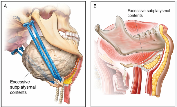 The Evolution of Double-Chin Surgery: From Liposuction to Pelican Surgery image 2